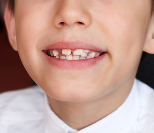 適切な位置に歯を誘導する矯正治療
