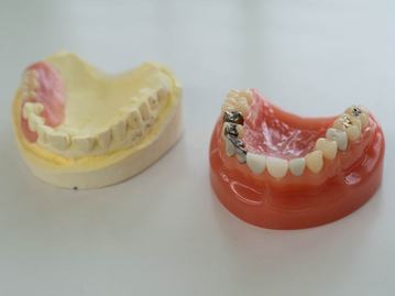 長い目で見た義歯の選択