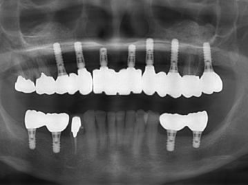 歯科インプラント治療