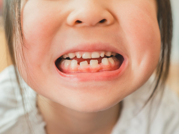 子供の歯から始める矯正治療①