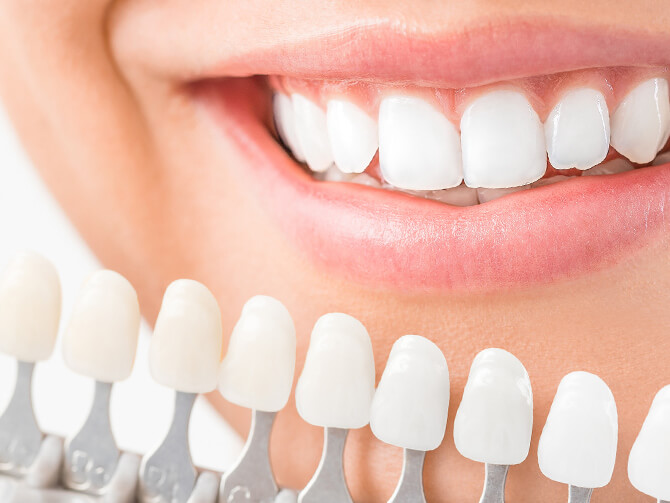 歯を白くするための治療メニュー