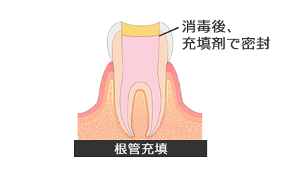【ひどい虫歯の治療1】根管治療②根管充填_その他