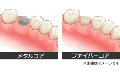 【ひどい虫歯の治療2】歯の土台の形成_その他