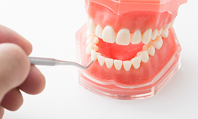 歯石が口臭の原因に！歯石を除去して口臭を防ぐ方法