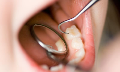 乳歯でも歯周病になるの？_その他